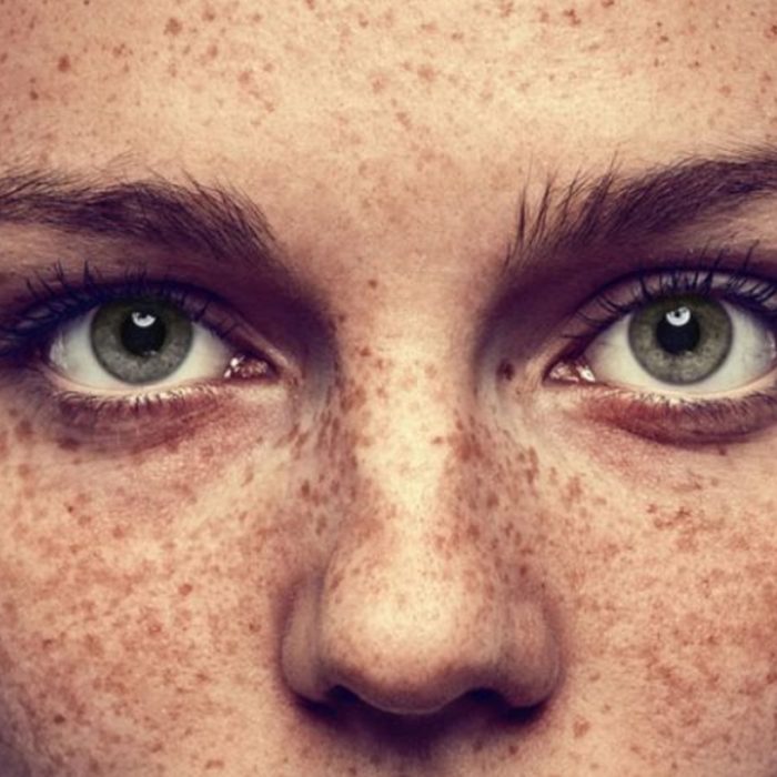 Laser Pigmentation Removal